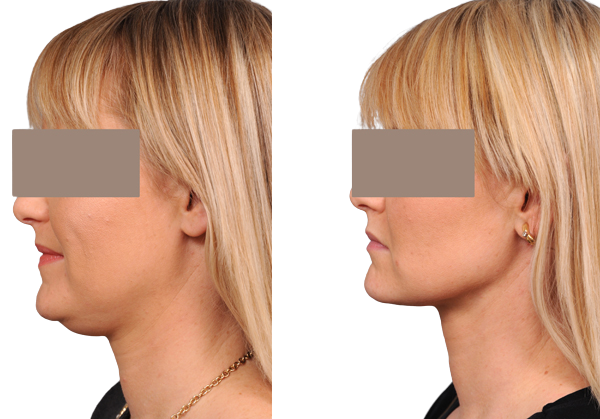 A patient before and after laser chin lipolysis